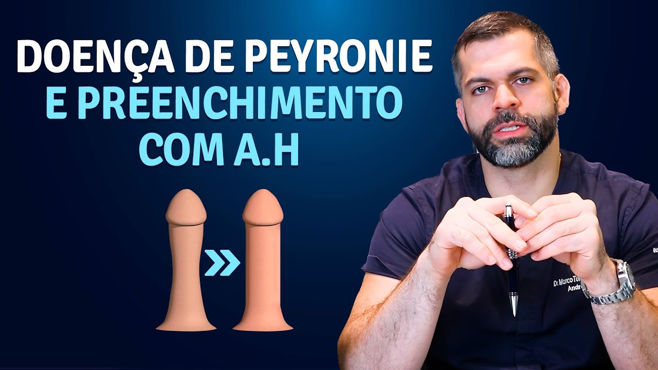 Canal do Dr. Marco Túlio Cavalcanti Doença de Peyronie e preenchimento com HA | Dr. Marco Túlio Cavalcanti – Andrologista e Urologista